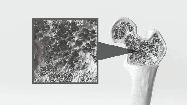 istock Osteoporosis stage 2 of 3 -- 3d rendering 1281584228