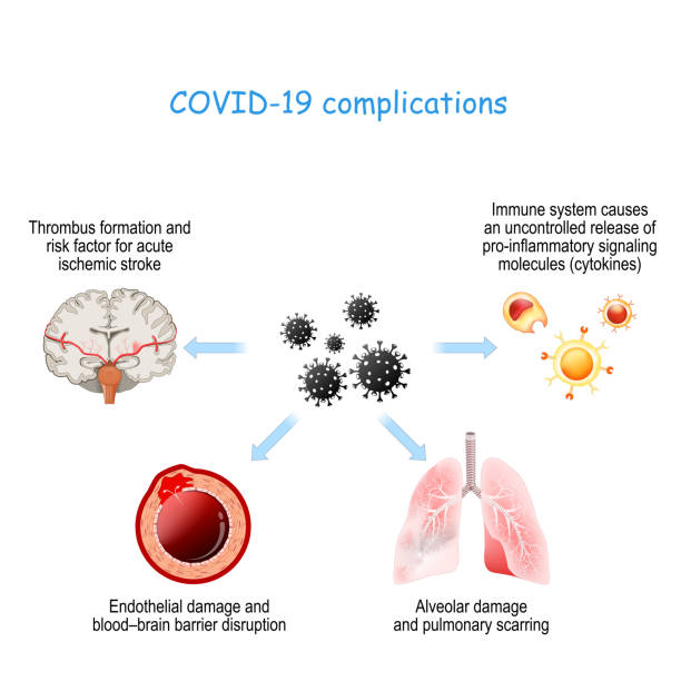 COVID-19 complications COVID-19 complications. Alveolar damage with pulmonary scarring, Thrombus formation, Endothelial damage, white blood cells and cytokine storm. endothelial stock illustrations