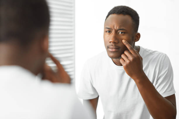 istock Worried Black Guy Touching Acne On Face Standing In Bathroom 1281659878