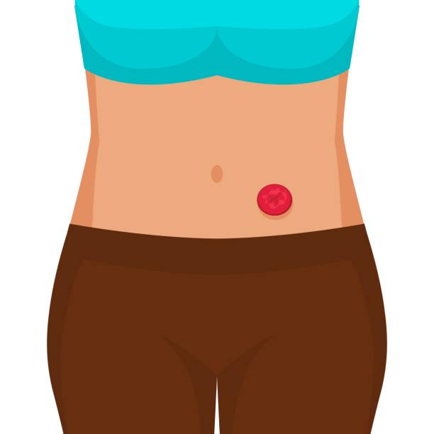 Young woman with stoma after colon cancer surgery Young woman with stoma after colon cancer surgery. Vector illustration colon cancer screening stock illustrations