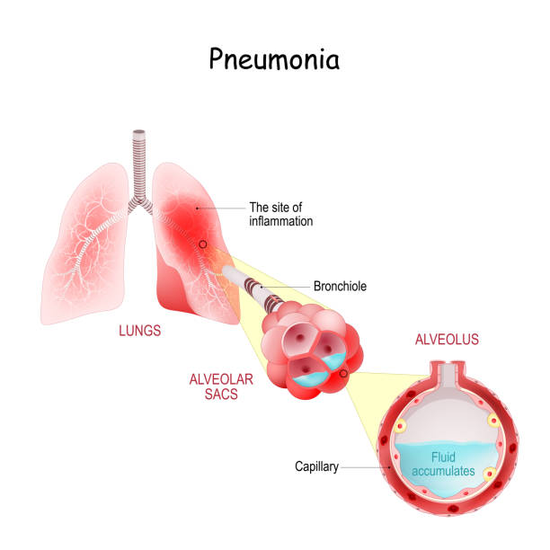 ilustraciones, imágenes clip art, dibujos animados e iconos de stock de sección transversal de los pulmones afectados por infección por coronavirus - neumonía