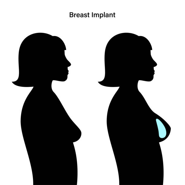 Breast Implant Concept Breast implant in female silhouette, subglandular placement. Bust enhancement operation, woman chest before and after plastic surgery. Infographic poster for clinic. Isolated flat vector illustration. silicone implants stock illustrations