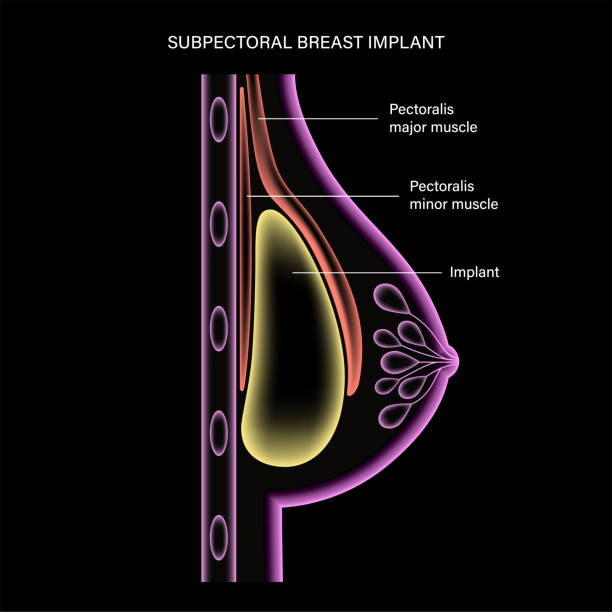 Breast Implant Concept Breast implant in female silhouette, subpectoral placement. 3d realistic infographic poster, x ray scanning. Bust enhancement operation, woman chest after plastic surgery. Isolated vector illustration silicone implants stock illustrations
