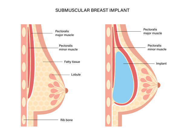 Breast Implant Concept Breast implant in female silhouette, submuscular placement. Bust enhancement operation, woman chest before and after plastic surgery. Infographic poster for clinic. Isolated flat vector illustration silicone stock illustrations