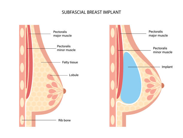 Breast Implant Concept Breast implant in female silhouette, subfascial placement. Bust enhancement operation, woman chest before and after plastic surgery. Infographic poster for clinic. Isolated flat vector illustration silicone implants stock illustrations