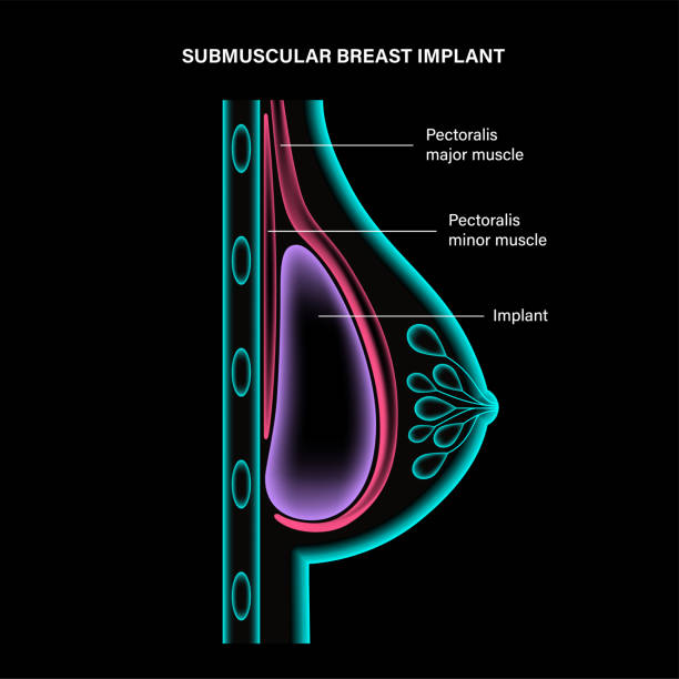 Breast Implant Concept Breast implant in female silhouette, submuscular placement. 3d realistic infographic poster, x ray scanning. Bust enhancement operation, woman chest after plastic surgery. Isolated vector illustration silicone implants stock illustrations