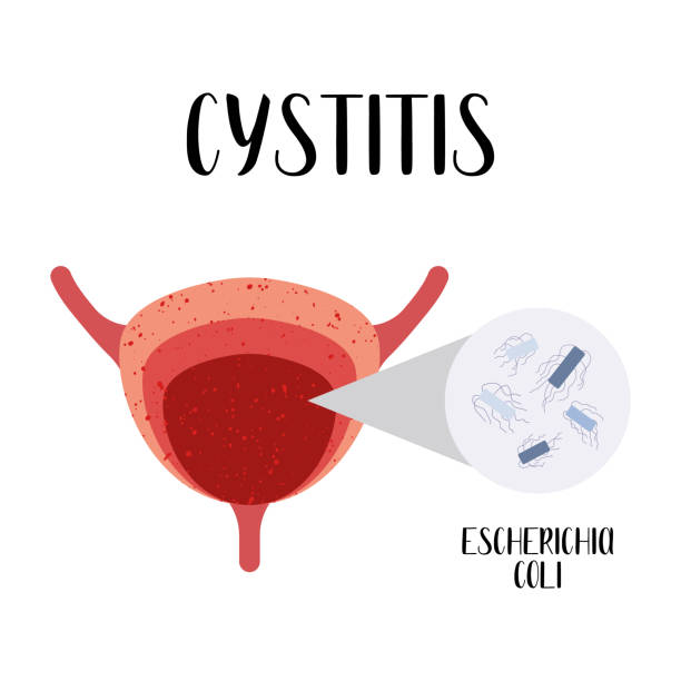 Cystitis Drawing 1,700+ Cystitis Stock Illustrations, Royalty-Free Vector Graphics ...