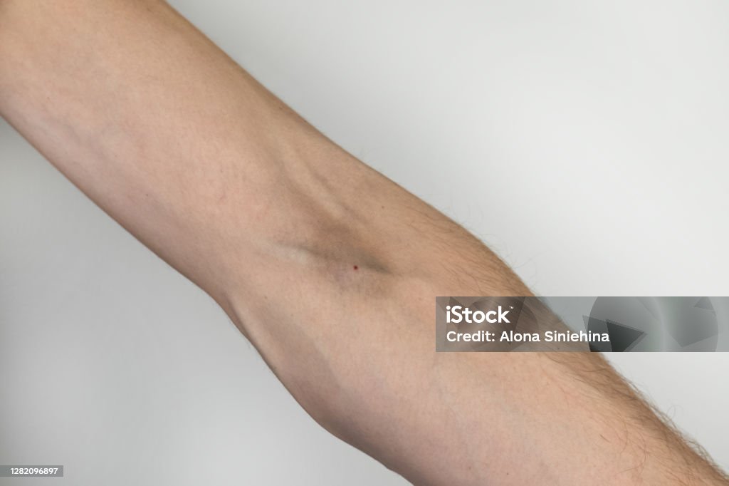 A male drug addict shows his hands and veins, which show bruises from the injections. The concept of dependence and injecting drugs into one’s veins. The concept of dependence and injecting drugs into one’s veins. A male drug addict shows his hands and veins, which show bruises from the injections. Bruise Stock Photo