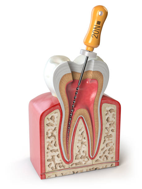 przekrój ludzkiego zęba z plikiem endodontycznym izolowanym na białym. - canal zdjęcia i obrazy z banku zdjęć