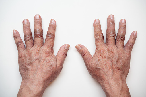 Medical condition of a pair of senior's hands with eczema and burning skin