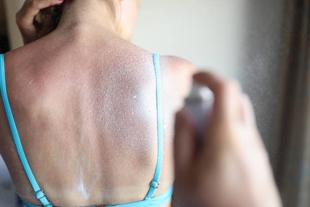 protective aerosol is applied to sunburn on woman's back - spray tan body human skin imagens e fotografias de stock