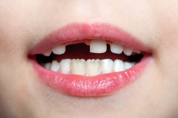 istock the child shows the first lost tooth 1282385591
