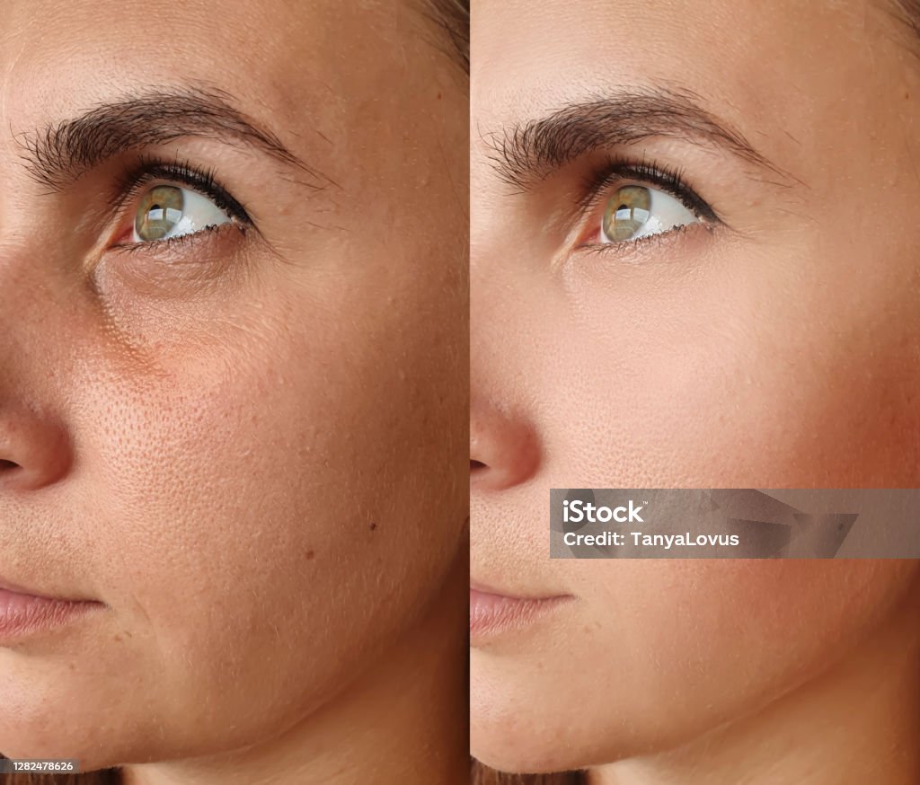 woman face wrinkles before and after treatment Before and After Stock Photo