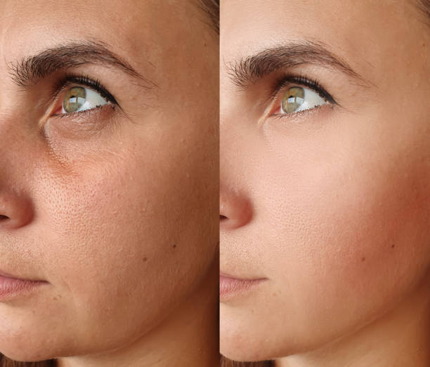 woman face wrinkles before and after treatment woman face wrinkles before and after treatment botox before and after stock pictures, royalty-free photos & images