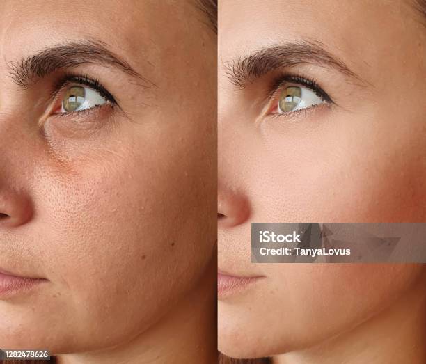 Woman Face Wrinkles Before And After Treatment Stock Photo - Download Image Now - Before and After, Botulinum Toxin Injection, Wrinkled