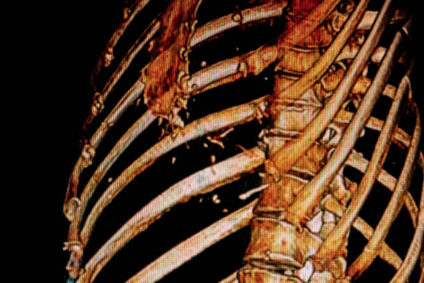 cat -scan della frattura della costola - human bone forensic science medical scan morphology foto e immagini stock