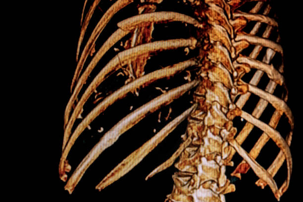 cat -scan złamania żeber - human bone forensic science medical scan morphology zdjęcia i obrazy z banku zdjęć