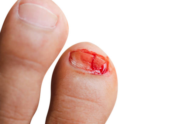 Broken Toe Nail Stock Photos, Pictures & Royalty-Free Images - iStock