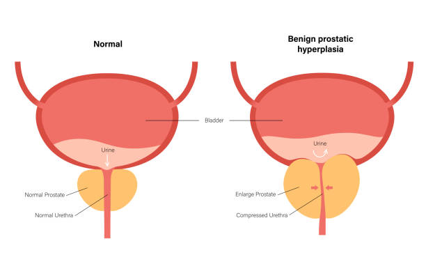 BPH info concept Benign prostatic hyperplasia logo for clinic. Normal bladder and BPH problem. Pain in male reproductive system concept. Human internal organs, prostate gland, bladder anatomy flat vector illustration. large stock illustrations