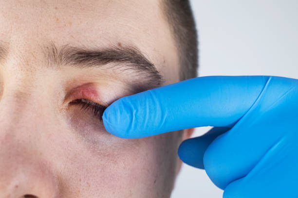 A doctor examines a patient who has blepharitis. Treatment of inflammation and redness of the eyelid. Infection of the skin around the eyes. The concept of providing quality medical care stock photo