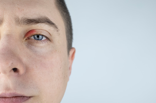 Redness of the skin around the eyes and blepharitis. A man stands in front of a mirror and sees inflammation of the upper eyelid.