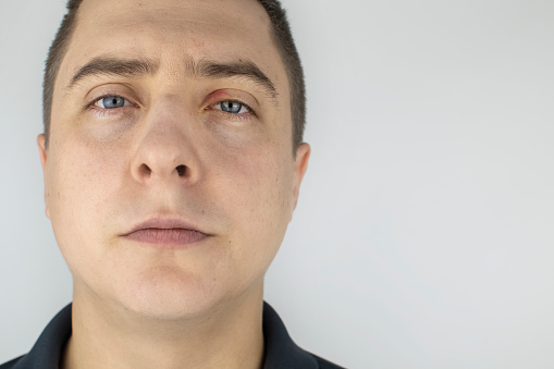 Redness of the skin around the eyes and blepharitis. A man stands in front of a mirror and sees inflammation of the upper eyelid.
