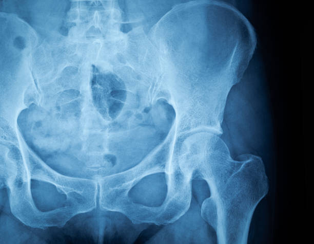 Pelvis X-Ray Image Pelvis X-Ray Image hip joint x stock pictures, royalty-free photos & images