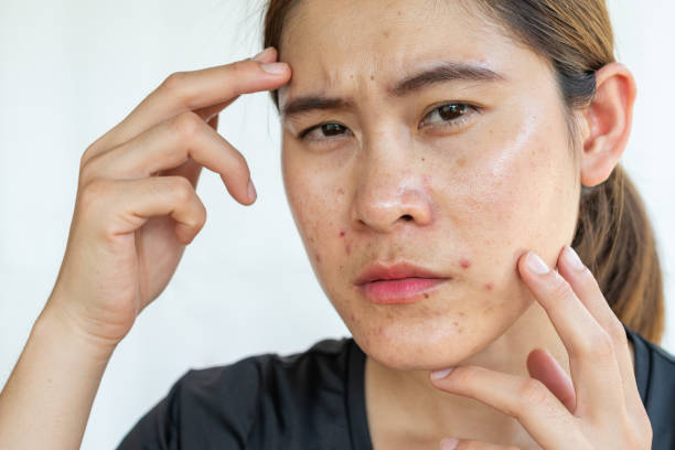 istock Asian woman having problems of acne inflamed on her face. 1282759430
