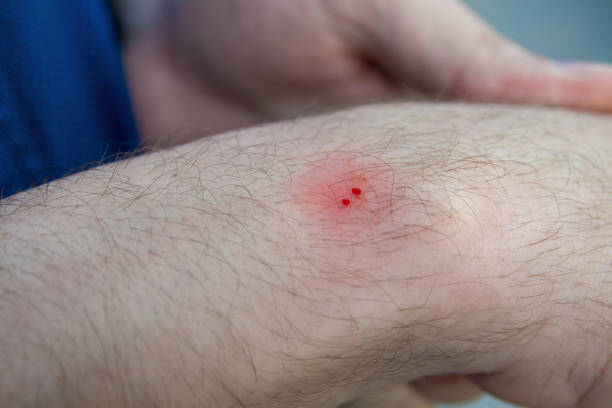 male hand with the wound from snake bite or snakebite. bite marks with blood drops and red skin. closeup, selective focus - biting imagens e fotografias de stock