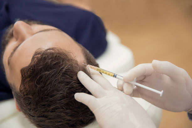 hair mesotherapy or scalp prp: platelet-rich plasma procedure. beautician doctor makes injections in the man head for hair growth to prevent hair loss and baldness - hair loss imagens e fotografias de stock