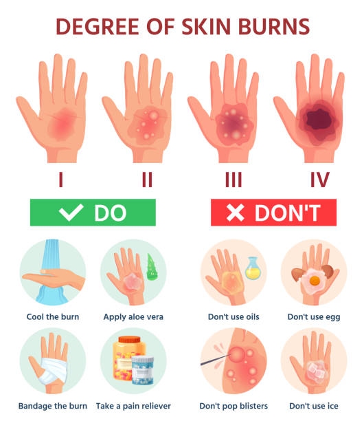 Burns degree. First aid for burn wound. Fire damage to skin classification. Hand blisters. Vector infographic treatment for thermal wound Burns degree. First aid for burn wound. Fire damage to skin classification. Hand blisters. Vector infographic treatment for thermal wound. Illustration injury pain damage, medicine help burning stock illustrations