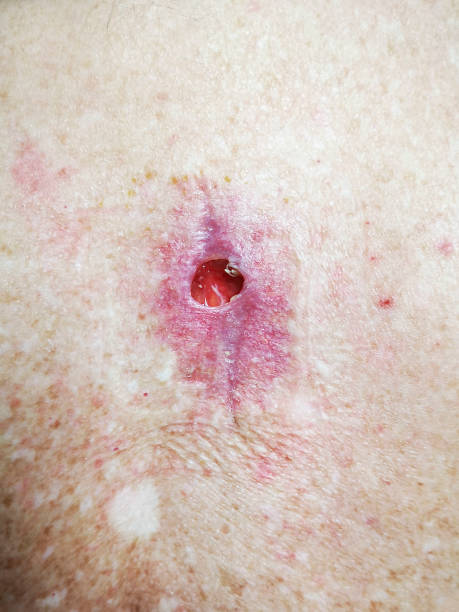 wound dehiscence efter avlägsnandet av en basalcellscancer carcinom. - basalcellscancer bildbanksfoton och bilder