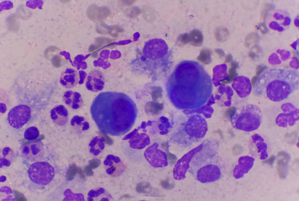 istock Mesothelial cells in body fluid sample. 1283046013
