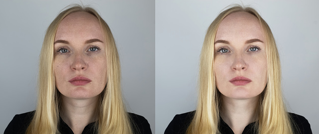 On the left is a picture of a face with pimples and enlarged pores, on the right is a clean face. Black dots, clogged pores on the nose and cheeks of a woman close-up. Photo before and after the girl.