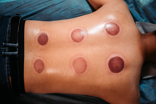 direct top angle of men rear skin after cupping therapy