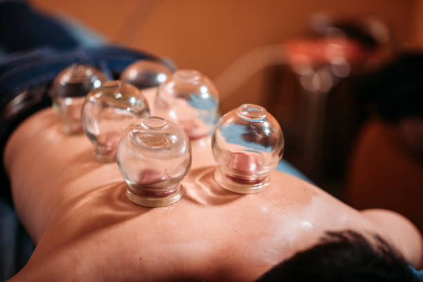 Asian chinese male patient receiving cupping therapy treatment at chinese medicine shop stock photo