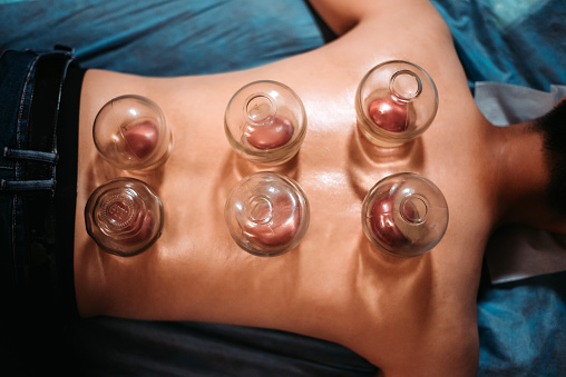 direct top angle of fews traditional chinese cupping on men rear skin