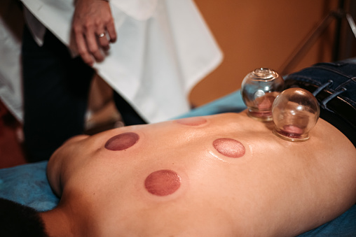 crop shot of doctor hand removed traditional chinese cupping from patient rear skin