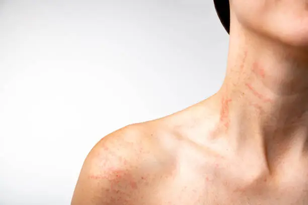 Allergic reaction to food, grass, skin rashes (hives or skin welts). Chronic urticaria, a reaction to heat, exercise, medication reactions or insects. Neck with allergic skin rash, isolated on white background. Symptoms like itchy skin, scratchy throat.