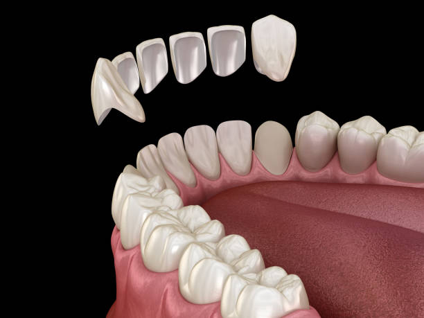 istock Veneer installation procedure over central incisor and lateral incisors. Medically accurate tooth 3D illustration 1283471874