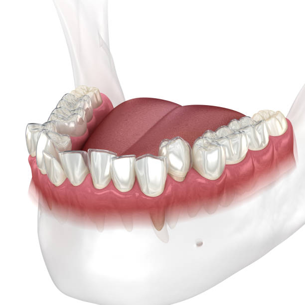 istock Invisalign braces or invisible retainer make bite correction. Medically accurate 3D animation 1283471880
