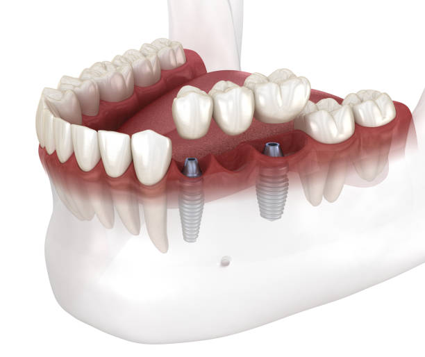 istock Dental bridge and crown placement over implants. Dental 3D animation concept 1283471888