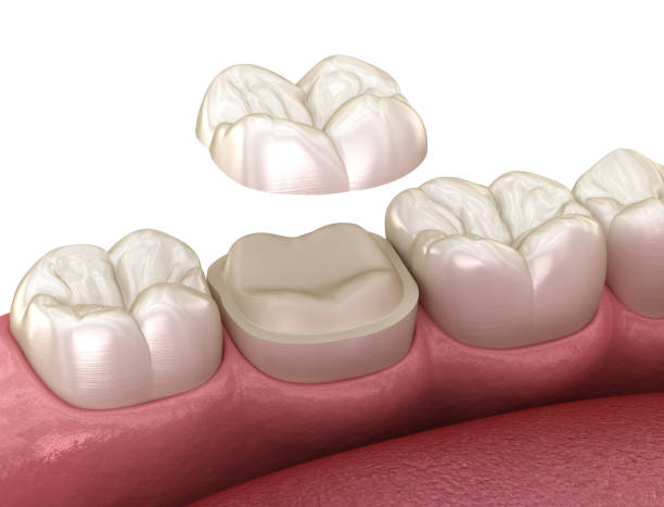 istock Onlay ceramic crown fixation over molar tooth. Medically accurate 3D illustration of human teeth treatment 1283471900