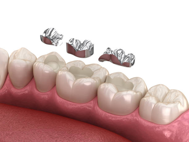 istock Amalgam restoration. Medically accurate 3D animation of dental concept 1283471902