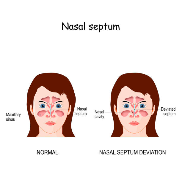 Nasal septum deviation. Nasal septum deviation. bone and cartilage in the nose that separates the nasal cavity into the two nostrils. difference and comparison of the nose with a normal and deviated septum septum stock illustrations
