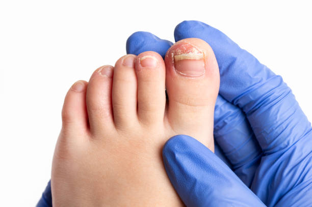 checking the left toe of a child Close-up image of doctor checking the left toe of a child suffering from nail fungus isolated on white trichophyton fungus stock pictures, royalty-free photos & images
