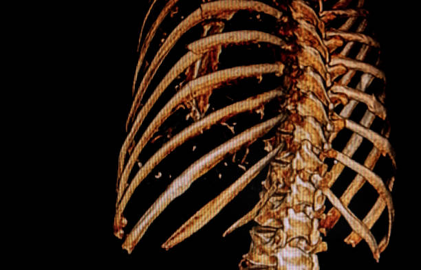 cat -scan złamania żeber - human bone forensic science medical scan morphology zdjęcia i obrazy z banku zdjęć