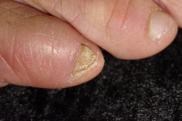 istock Fungus on human toenail, closeup. 1283694511
