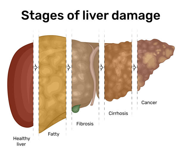 ilustracja stopniowego uszkodzenia wątroby - cirrhosis stock illustrations