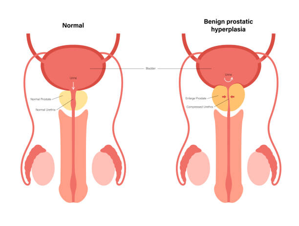Bph Info Concept Stock Illustration - Download Image Now - Prostate Gland,  Diagram, Incontinence - iStock